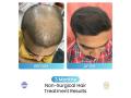 Dr Stuti Khare Shukla's Non-Surgical Hair Growth Booster helping multiple people suffering from Hair Loss Issues - Hindi News | Dr Stuti Khare Shukla's Non-Surgical Hair Growth Booster helping multiple people suffering from Hair Loss Issues | Latest business News at Lokmattimes.com