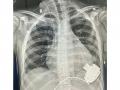 Uzbeki child with end-stage heart failure recovers after receiving mechanical heart (LVAD) - Hindi News | Uzbeki child with end-stage heart failure recovers after receiving mechanical heart (LVAD) | Latest national News at Lokmattimes.com