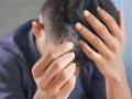 What Are the Main Causes of Hair Fall in Men? - Hindi News | What Are the Main Causes of Hair Fall in Men? | Latest business News at Lokmattimes.com
