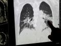 COVID-19 Omicron variant lung damage 'milder than Delta in animals': Study - Hindi News | COVID-19 Omicron variant lung damage 'milder than Delta in animals': Study | Latest international News at Lokmattimes.com
