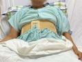47-kg tumour removed from woman's abdomen - Hindi News | 47-kg tumour removed from woman's abdomen | Latest health News at Lokmattimes.com