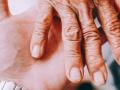 Long-term implications of arthritis if left untreated - Hindi News | Long-term implications of arthritis if left untreated | Latest lifestyle News at Lokmattimes.com