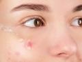 The importance of cleaning clogged pores - Hindi News | The importance of cleaning clogged pores | Latest lifestyle News at Lokmattimes.com