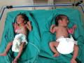 Mentally unstable woman abandons twins in Surat hospital - Hindi News | Mentally unstable woman abandons twins in Surat hospital | Latest national News at Lokmattimes.com