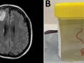 8-cm live worm removed from woman's brain in world's 1st discovery - Hindi News | 8-cm live worm removed from woman's brain in world's 1st discovery | Latest international News at Lokmattimes.com