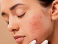 Home remedies to fight hormonal acne - Hindi News | Home remedies to fight hormonal acne | Latest lifestyle News at Lokmattimes.com