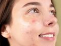 Medicines to prevent an acne breakout before your period - Hindi News | Medicines to prevent an acne breakout before your period | Latest lifestyle News at Lokmattimes.com