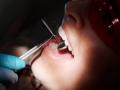 Clinical study finds new target drug for treating toothaches - Hindi News | Clinical study finds new target drug for treating toothaches | Latest health News at Lokmattimes.com