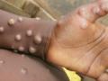 13 African countries report 6,883 monkeypox cases in 2022 - Hindi News | 13 African countries report 6,883 monkeypox cases in 2022 | Latest health News at Lokmattimes.com