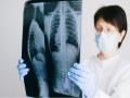 Study suggests new biomarker speeds identification of lung disease - Hindi News | Study suggests new biomarker speeds identification of lung disease | Latest technology News at Lokmattimes.com