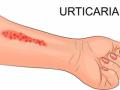 Urticaria: Managing a skin disorder that needs urgent medical care - Hindi News | Urticaria: Managing a skin disorder that needs urgent medical care | Latest health News at Lokmattimes.com
