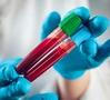 Blood-biomarker tests may aid in early diagnosis of Alzheimer’s: Report - Hindi News | Blood-biomarker tests may aid in early diagnosis of Alzheimer’s: Report | Latest health News at Lokmattimes.com