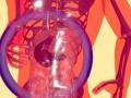 Liver Cirrhosis - Hindi News | Liver Cirrhosis | Latest lifestyle News at Lokmattimes.com