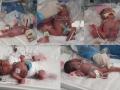 Quintuplets born for 1st time in 34 yrs in S.Korea - Hindi News | Quintuplets born for 1st time in 34 yrs in S.Korea | Latest international News at Lokmattimes.com