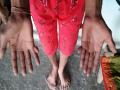 This MP family members have 12 fingers in hand and feet - Hindi News | This MP family members have 12 fingers in hand and feet | Latest national News at Lokmattimes.com