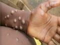Nigeria issues measures to prevent possible spread of monkeypox - Hindi News | Nigeria issues measures to prevent possible spread of monkeypox | Latest international News at Lokmattimes.com