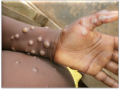 Mpox cases in Africa surpass 190,000, deaths near 2,000: Africa CDC - Hindi News | Mpox cases in Africa surpass 190,000, deaths near 2,000: Africa CDC | Latest health News at Lokmattimes.com