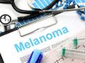 Antibiotics might help in treatment of melanoma - Hindi News | Antibiotics might help in treatment of melanoma | Latest technology News at Lokmattimes.com