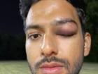 Former India U-19 star Unmukt Chand suffers serious eye injury; says grateful to have survived a possible disaster