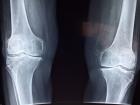 Octagenarian undergoes successful total knee replacement surgery