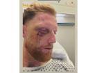 England Test captain Ben Stokes undergoes successful facial surgery