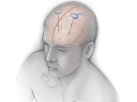 Doctors of Ganga Ram Hospital performs rare surgery for patient suffering from Parkinson - News | Doctors of Ganga Ram Hospital performs rare surgery for patient suffering from Parkinson | Latest national News at Lokmattimes.com