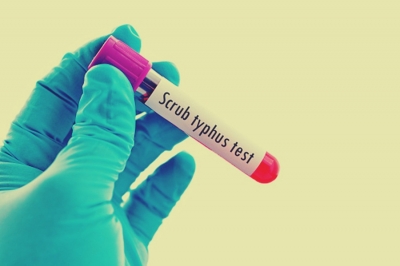 Scrub typhus cases found in UP | Scrub typhus cases found in UP