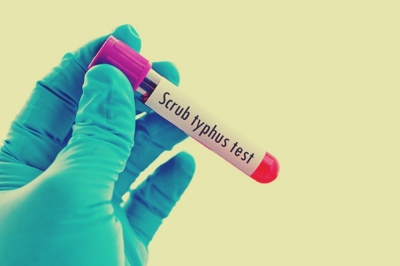 Scrub typhus cases found in UP | Scrub typhus cases found in UP Scrub typhus cases found in UP | Scrub typhus cases found in UP