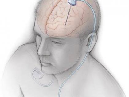 Video games during brain surgery to open new treatments for Parkinson's | Video games during brain surgery to open new treatments for Parkinson's Video games during brain surgery to open new treatments for Parkinson's | Video games during brain surgery to open new treatments for Parkinson's