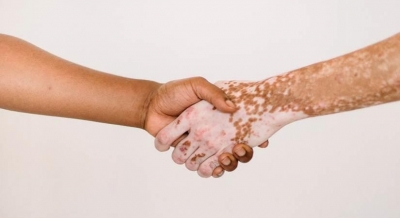 Signs to detect Vitiligo | Signs to detect Vitiligo