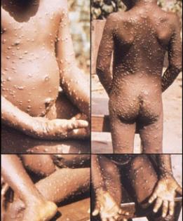 Monkeypox spreads to more than 20 countries: WHO | Monkeypox spreads to more than 20 countries: WHO