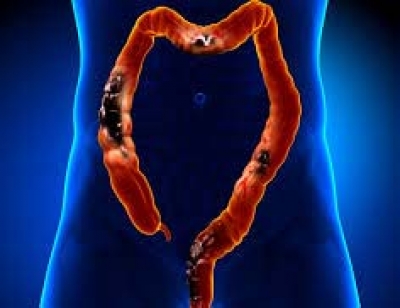 Study shows how stress worsens colorectal cancer | Study shows how stress worsens colorectal cancer