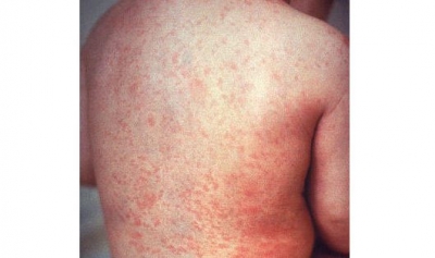 Measles outbreak in UP village, three children die | Measles outbreak in UP village, three children die