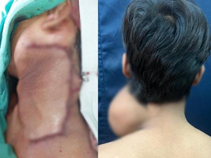 BMC hospital removes 2.5 kg tumour from teen's neck after 7 hr surgery | BMC hospital removes 2.5 kg tumour from teen's neck after 7 hr surgery BMC hospital removes 2.5 kg tumour from teen's neck after 7 hr surgery | BMC hospital removes 2.5 kg tumour from teen's neck after 7 hr surgery