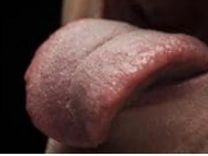 Delhi doctors remove tumour made up of blood vessels from man's tongue | Delhi doctors remove tumour made up of blood vessels from man's tongue Delhi doctors remove tumour made up of blood vessels from man's tongue | Delhi doctors remove tumour made up of blood vessels from man's tongue
