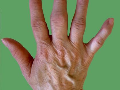 Study shows common drug can improve hand osteoarthritis symptoms | Study shows common drug can improve hand osteoarthritis symptoms Study shows common drug can improve hand osteoarthritis symptoms | Study shows common drug can improve hand osteoarthritis symptoms