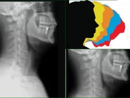 Rising 'text-neck syndrome' accounts for 70% OPD visits: Doctors | Rising 'text-neck syndrome' accounts for 70% OPD visits: Doctors Rising 'text-neck syndrome' accounts for 70% OPD visits: Doctors | Rising 'text-neck syndrome' accounts for 70% OPD visits: Doctors