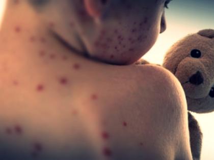 1.1mn Indian children missed measles vaccine in 2022: WHO | 1.1mn Indian children missed measles vaccine in 2022: WHO