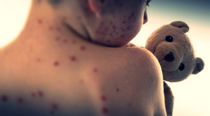 Covid has increased risk of measles, brain disorder | Covid has increased risk of measles, brain disorder