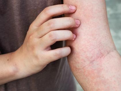 Study finds common microbe that causes persistent itching | Study finds common microbe that causes persistent itching Study finds common microbe that causes persistent itching | Study finds common microbe that causes persistent itching