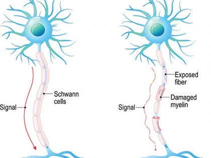 New stem cell therapy may halt multiple sclerosis progression | New stem cell therapy may halt multiple sclerosis progression New stem cell therapy may halt multiple sclerosis progression | New stem cell therapy may halt multiple sclerosis progression