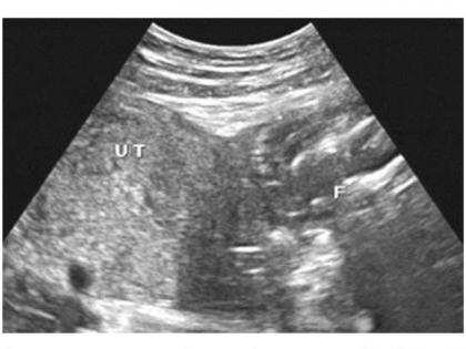 BMC hospital saves mother with ruptured uterus having dead baby | BMC hospital saves mother with ruptured uterus having dead baby BMC hospital saves mother with ruptured uterus having dead baby | BMC hospital saves mother with ruptured uterus having dead baby