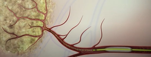 New minimally invasive therapy shows promise for liver cancer patients | New minimally invasive therapy shows promise for liver cancer patients New minimally invasive therapy shows promise for liver cancer patients | New minimally invasive therapy shows promise for liver cancer patients