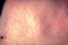 Measles cases triggers alert in Australia | Measles cases triggers alert in Australia