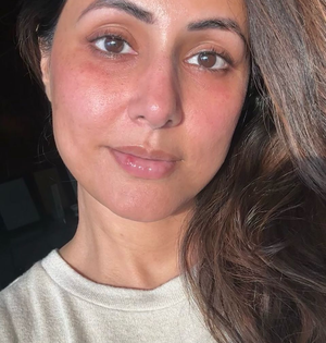 Hina Khan shares raw no-filter selfie with red rashes, blisters on lips | Hina Khan shares raw no-filter selfie with red rashes, blisters on lips