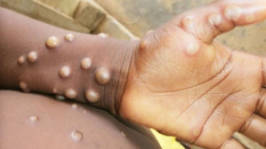 Monkeypox case detected in South Africa | Monkeypox case detected in South Africa