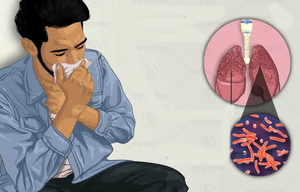 TB diagnosis must go beyond persistent cough: Lancet study | TB diagnosis must go beyond persistent cough: Lancet study