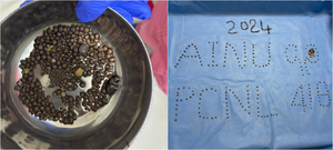 418 kidney stones removed from patient at Hyderabad’s AINU | 418 kidney stones removed from patient at Hyderabad’s AINU 418 kidney stones removed from patient at Hyderabad’s AINU | 418 kidney stones removed from patient at Hyderabad’s AINU