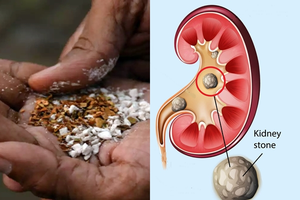 Pan masala can cause larger kidney stones: Experts | Pan masala can cause larger kidney stones: Experts Pan masala can cause larger kidney stones: Experts | Pan masala can cause larger kidney stones: Experts