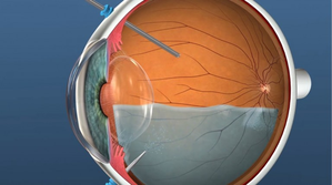 Vitrectomy: The surgery to treat retinal damage due to diabetes or digital screens | Vitrectomy: The surgery to treat retinal damage due to diabetes or digital screens Vitrectomy: The surgery to treat retinal damage due to diabetes or digital screens | Vitrectomy: The surgery to treat retinal damage due to diabetes or digital screens